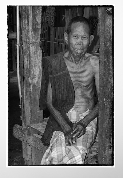 Man at Leprosy Village Suffering Quietly